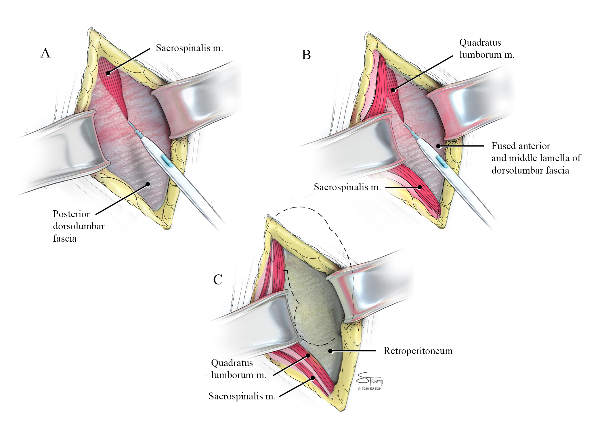 Dorsal lumbotomy. Three illustrations from a larger series depicting the surgical process. Here the retractors pull the outer layers apart to permit the cautery device to gain access into the deeper layers of tissue