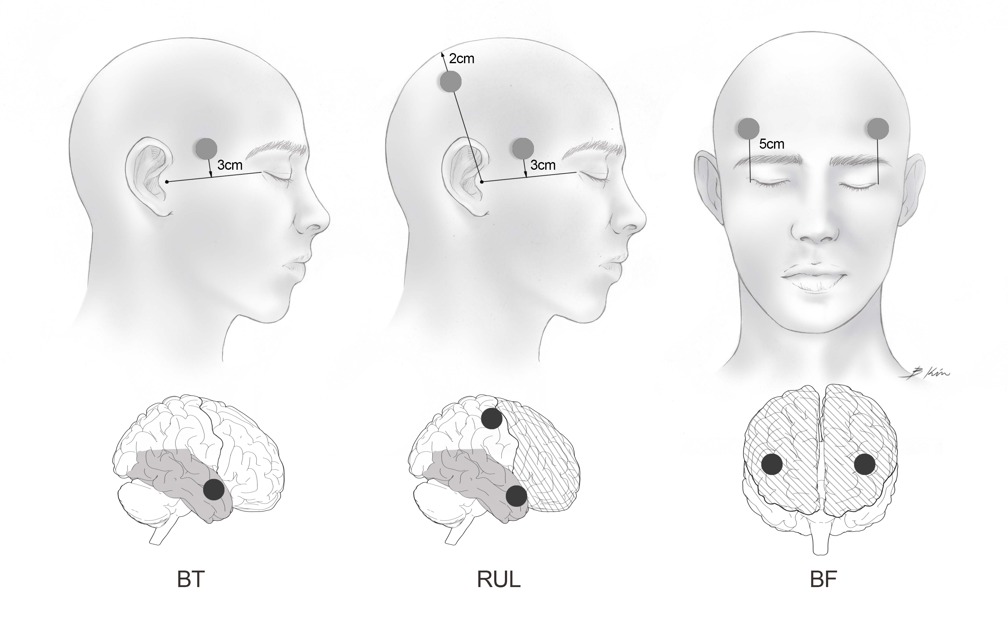 Three neurosurgery illustrations depicting various craniotomy sites and measurements to allow the surgeon to gain access to different parts of the brain based on surface anatomy