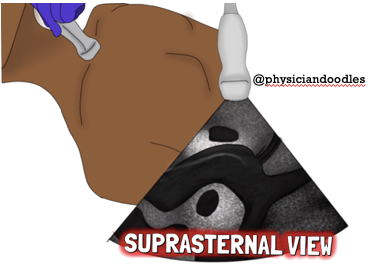 Illustration of ultrasound wand placed at the sternum to show suprasternal view of ches