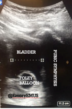 Pelvic ultrasound image showing bladder, public symphysis and foley balloon