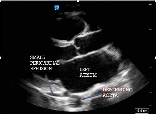 PL ultrasound animation showing small pericardial effusion, left atrium, descending aorta