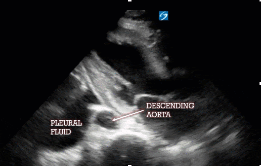 PL ultrasound animation showing pleural fluid and descending aorta