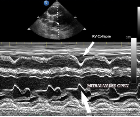 M-Mode for Pneumothorax  Emory School of Medicine