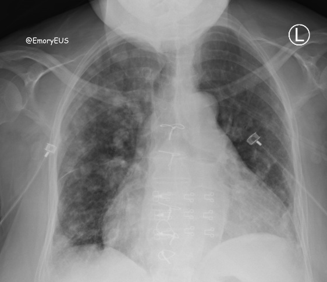 ALMAG-02 – lung recovery after pneumonia incl. COVID19