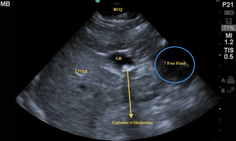 abdominal aortic aneurysm ultrasound