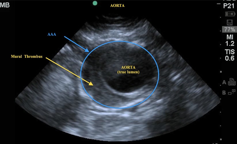 a Abdominal Aortic Aneurysm Emory School Of Medicine