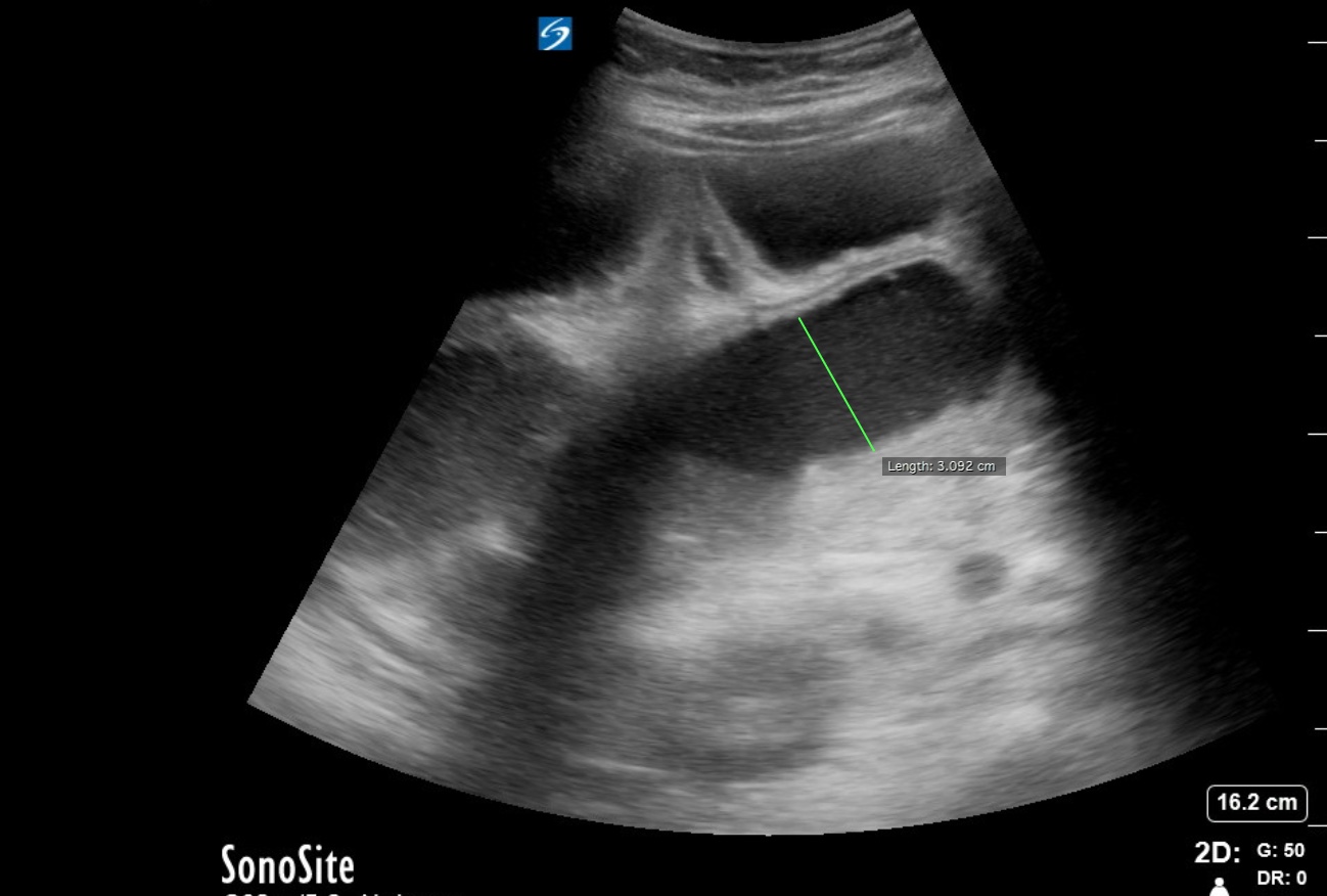 Know What to Do If You Have Bowel Obstruction [Part 1 of 5] 