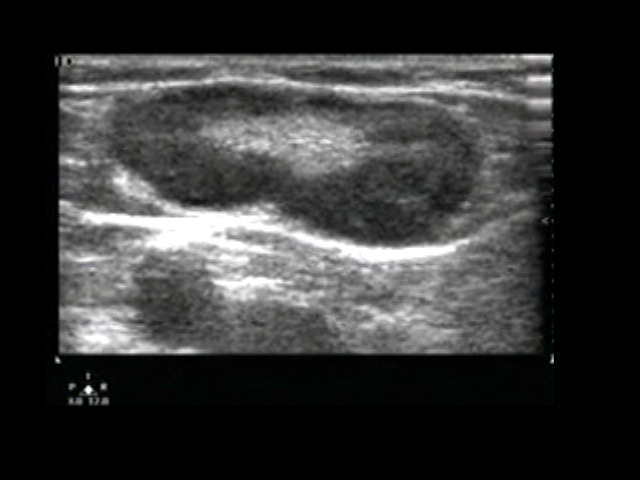 Ultrasound Images Soft Tissue Emory School Of Medicine