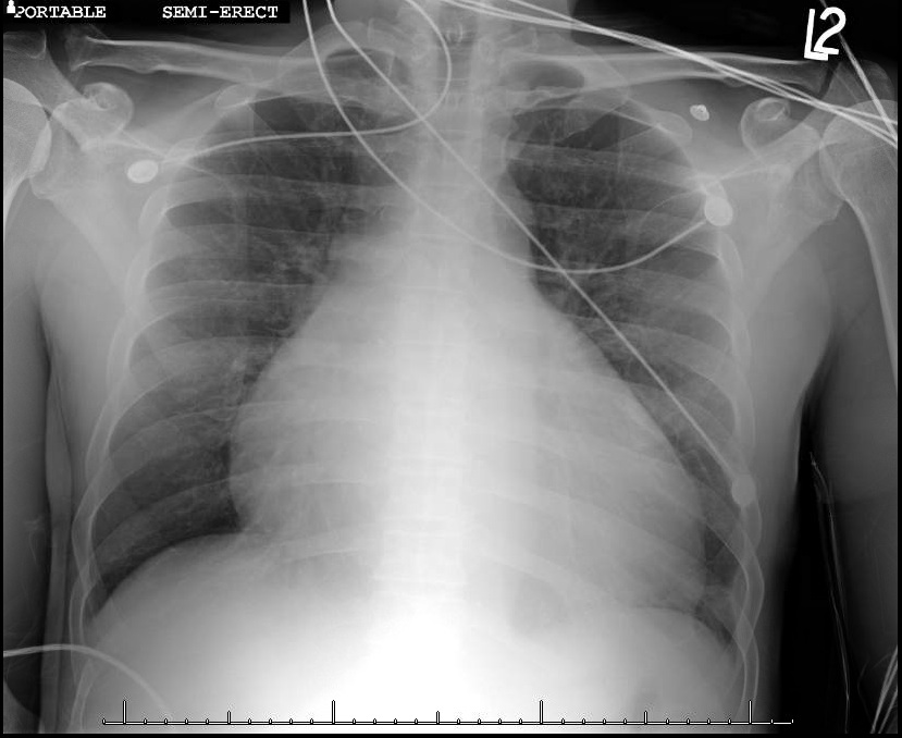 pericardial effusion x ray