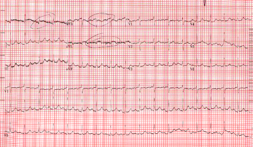 ekg