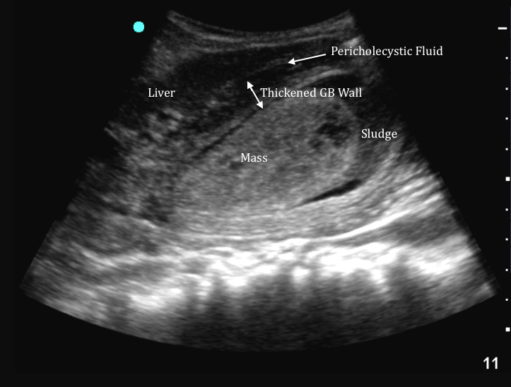 abnormal gallbladder ultrasound