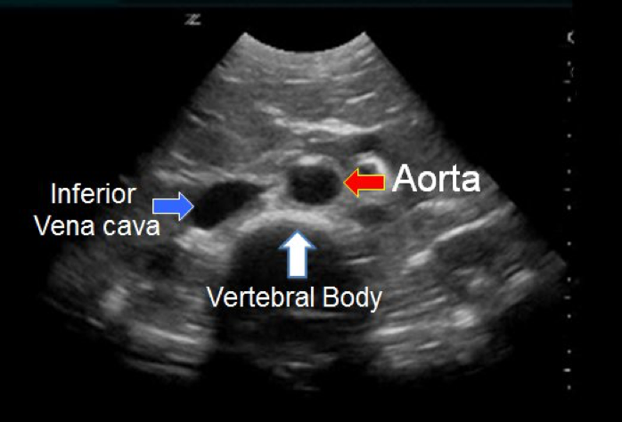 Aorta1