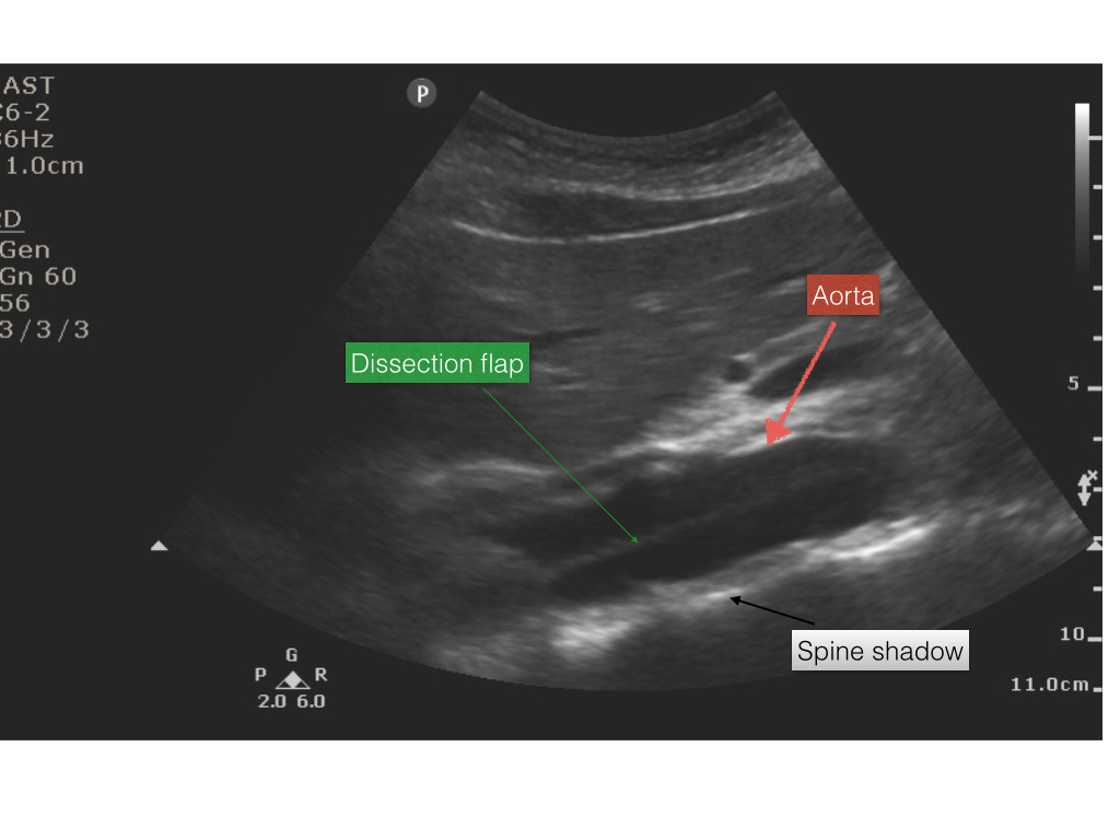 aortic dissection