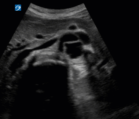 Aorta Ultrasound