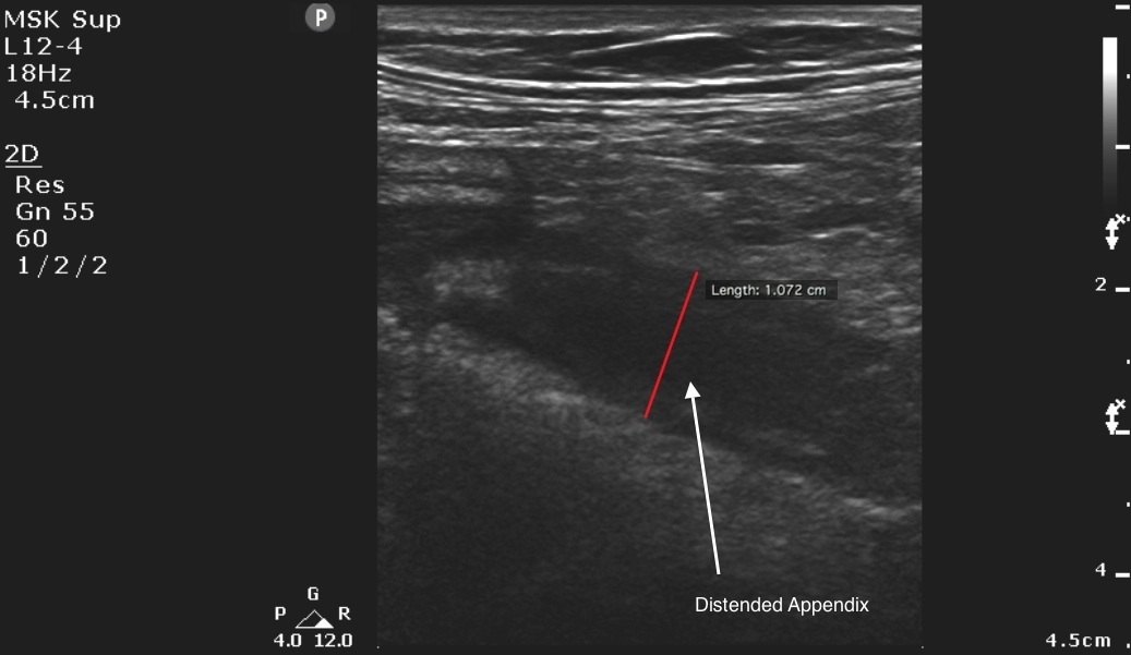 ruptured appendix ultrasound