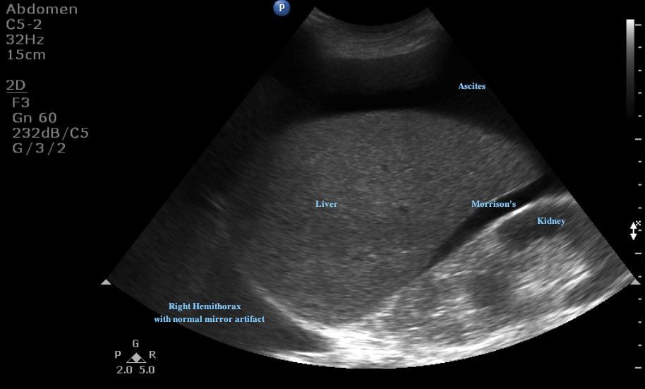 Ultrasound: Small pocket of ascites.