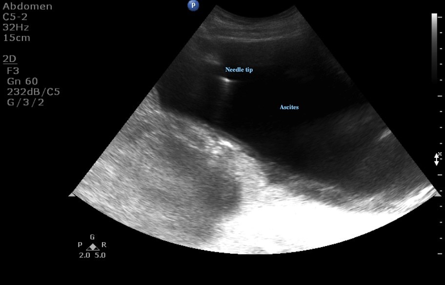 Paracentesis Ultrasound