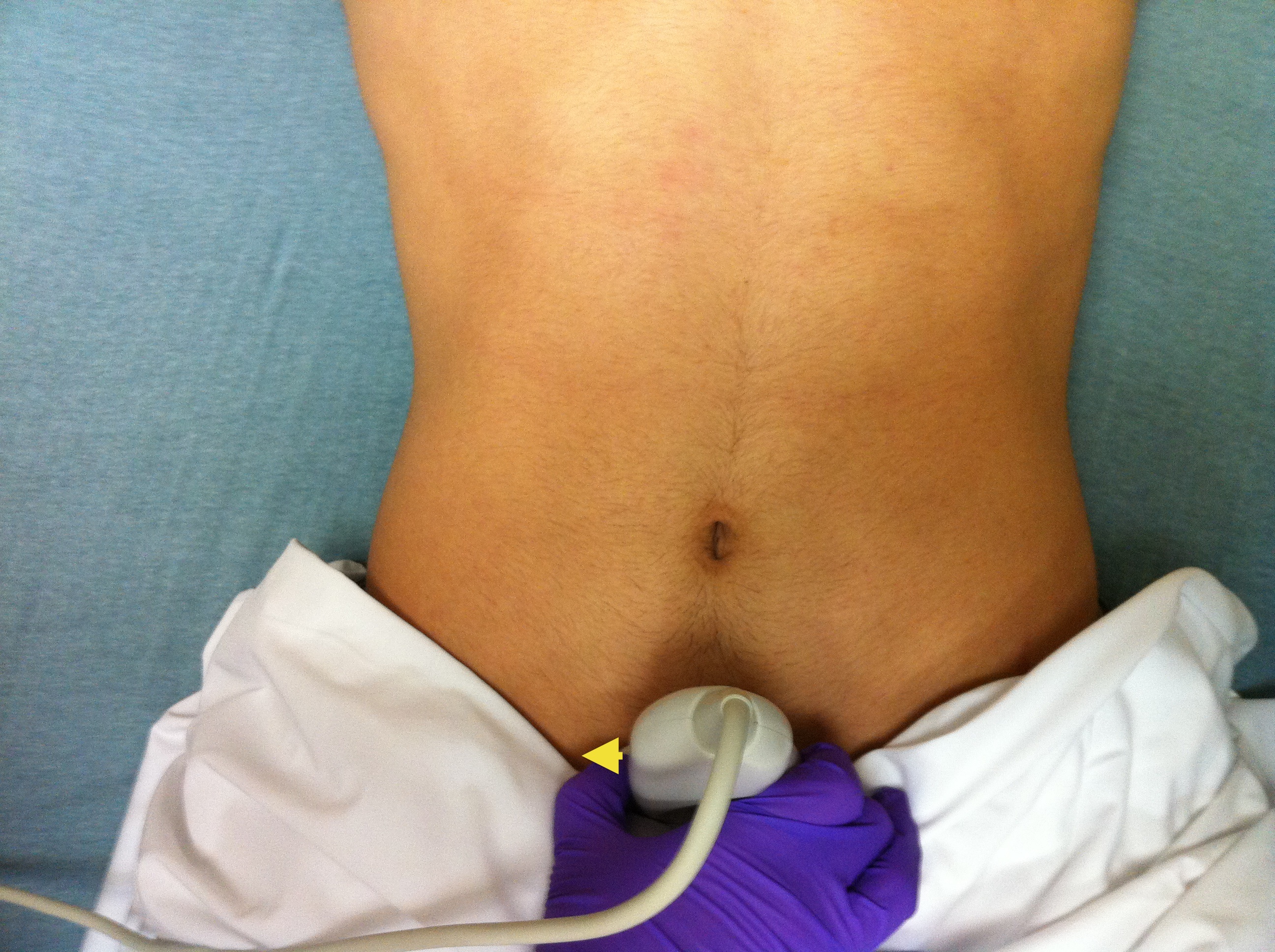 Flank pain radiating to the suprapubic region