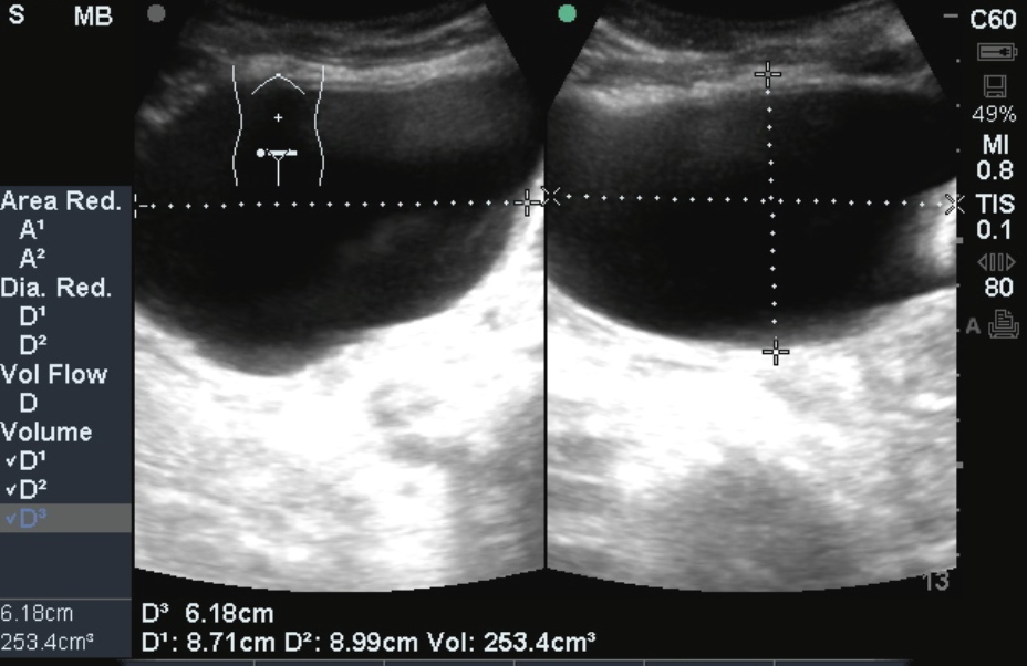 post void bladder volume in cc