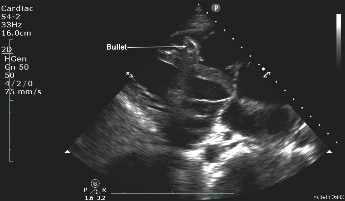 heart sonogram