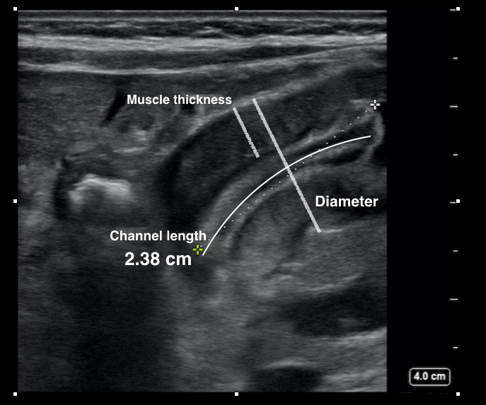 pyloric stenosis ultrasound protocol