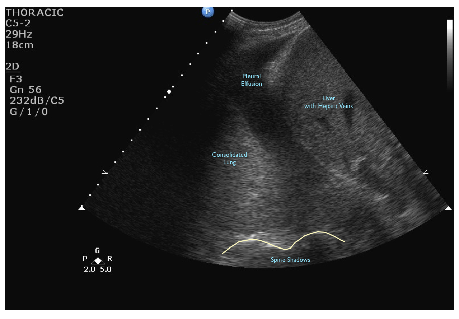 lung consolidation vs pleural effusion