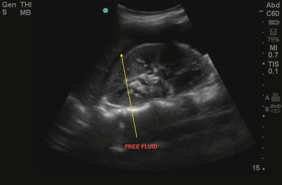 Ruptured Ectopic Pregnancy Ultrasound 