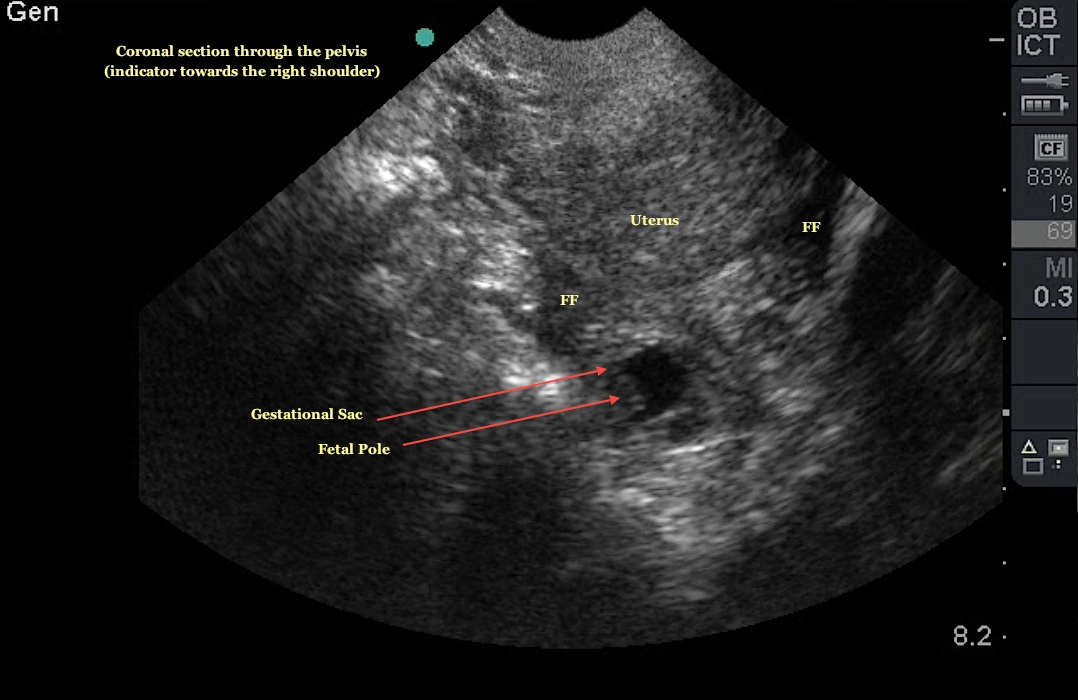 ruptured ectopic pregnancy ultrasound