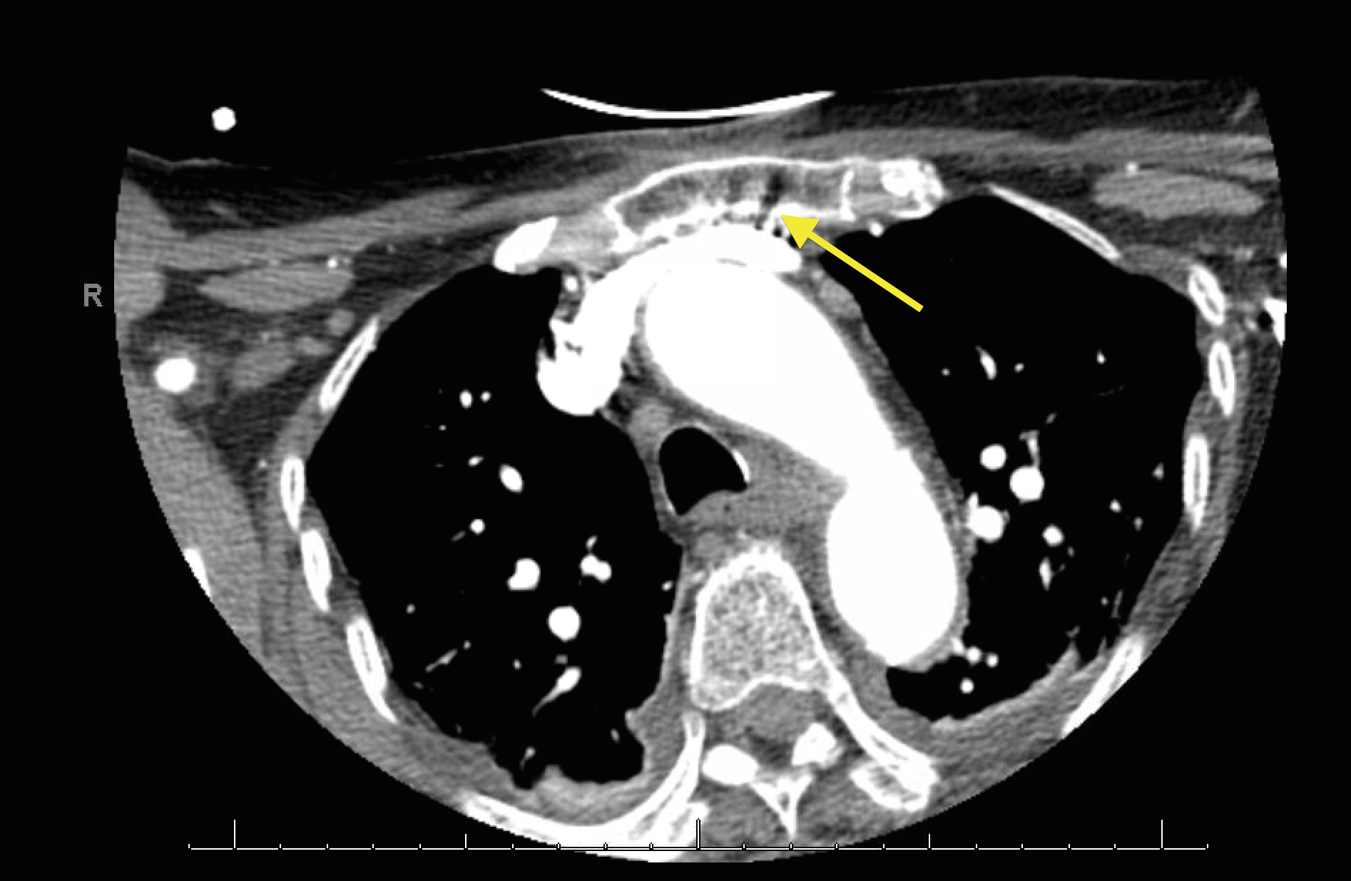 Ct sternal fracture