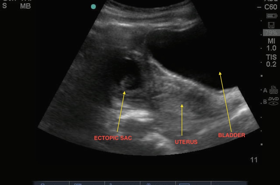 9 Week Ectopic Pregnancy Ultrasound