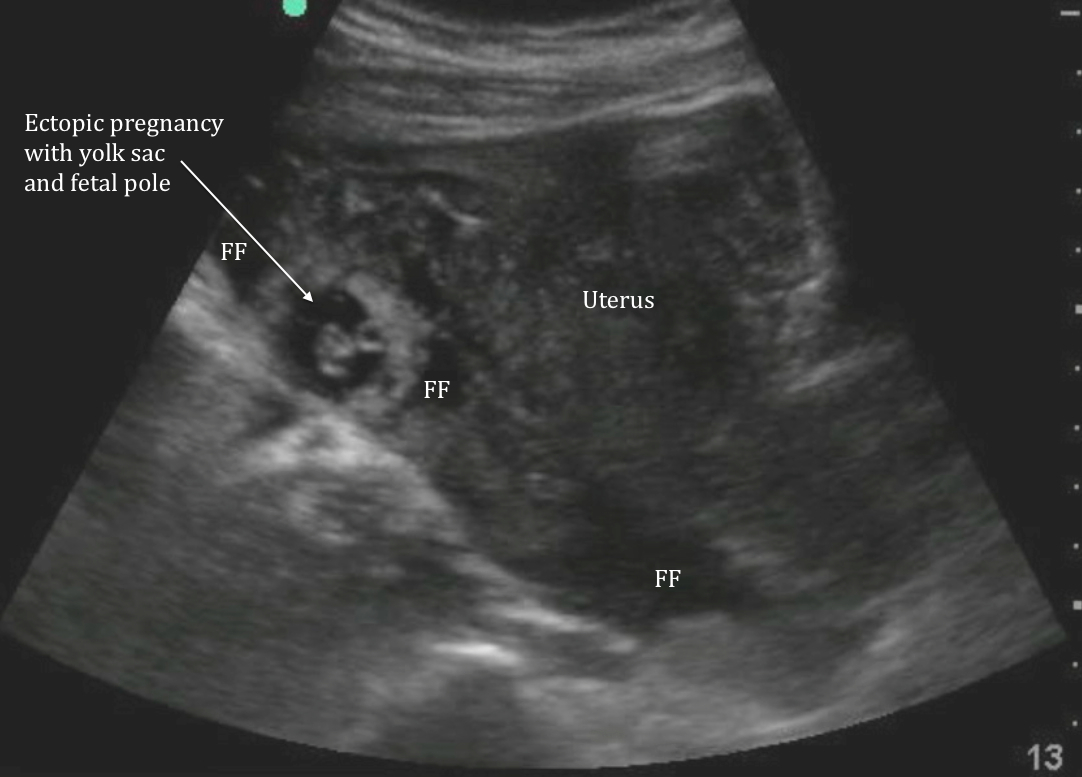 ectopic pregnancy ultrasound