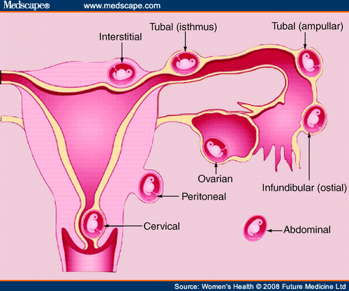 molar pregnancy