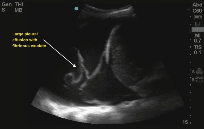 pleural effusion ultrasound