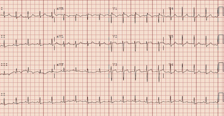 EKG