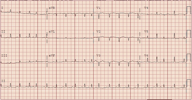 EKG