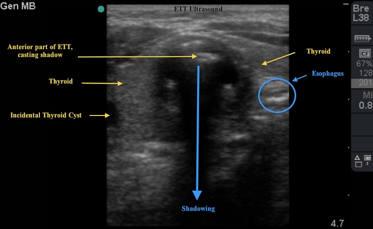 labeled thyroid ultrasound