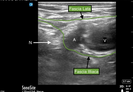 Femoral nerve labelled