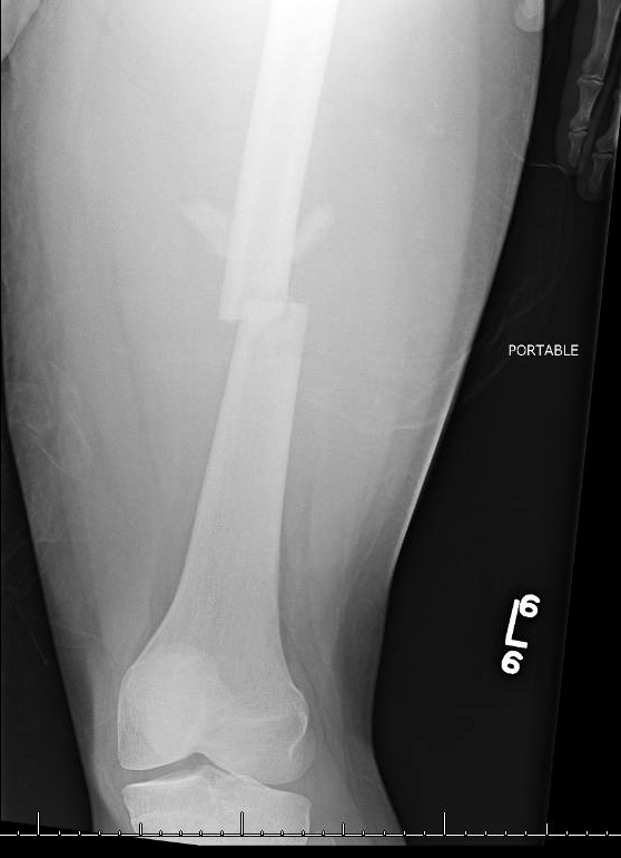 femur fx