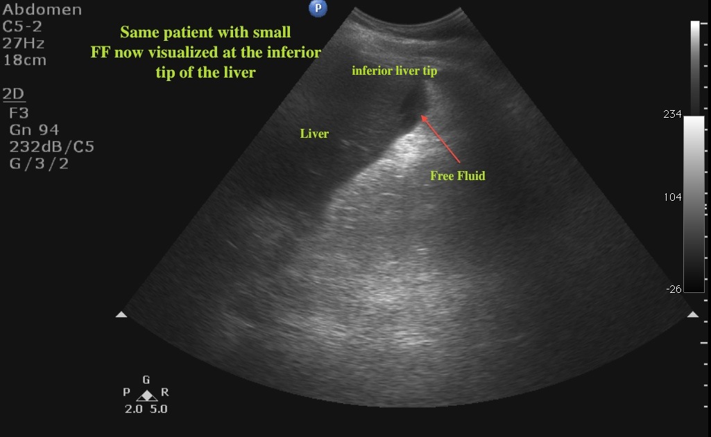 ff at the liver tip