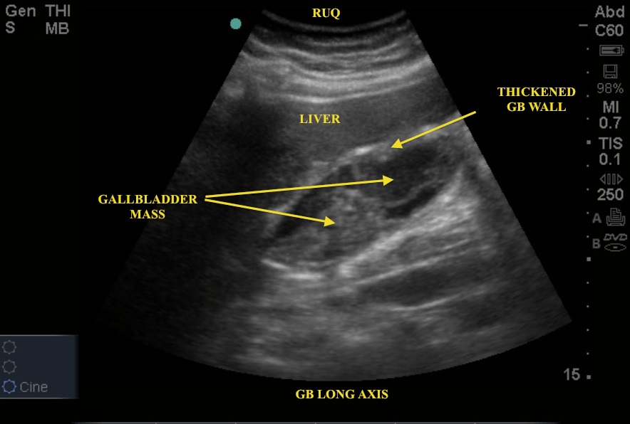 diseased gallbladder ultrasound