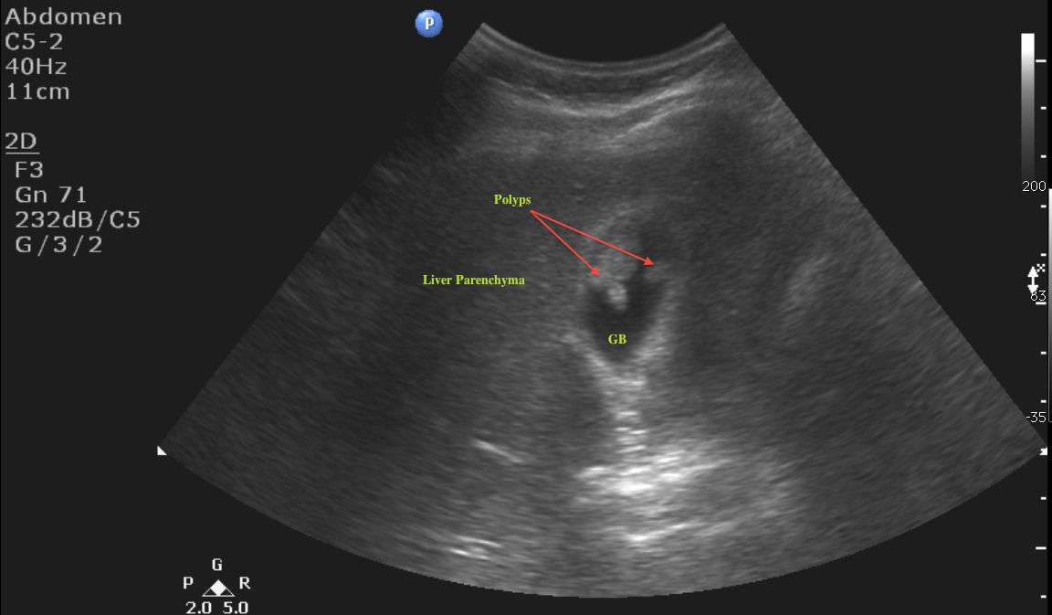 Gallbladder Ultrasound Stones