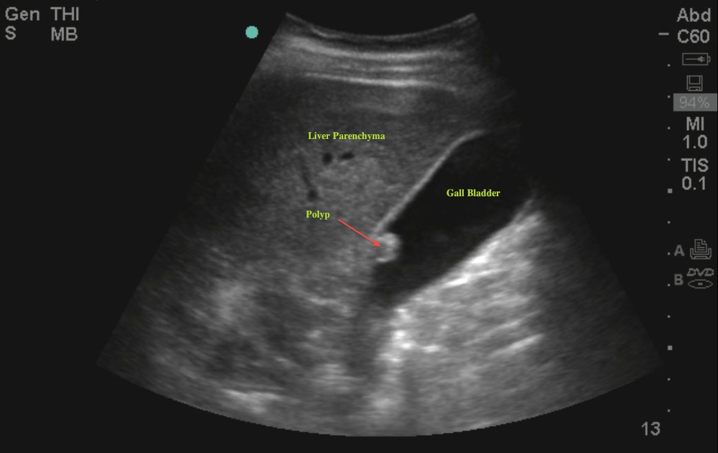 Gallbladder Ultrasound Cancer