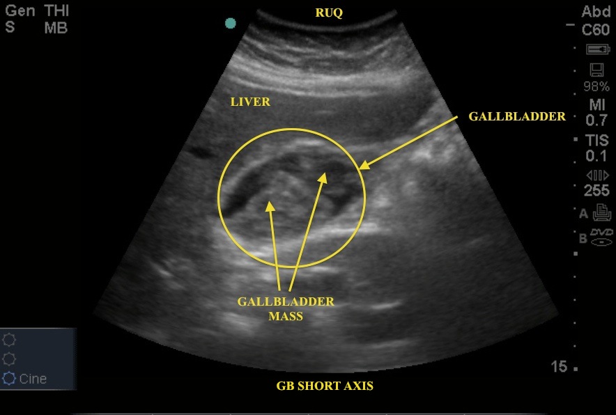 Gallbladder Anatomy Ultrasound