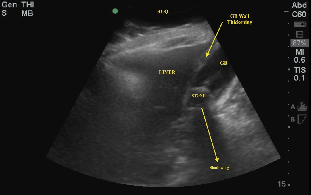 bladder stone ultrasound