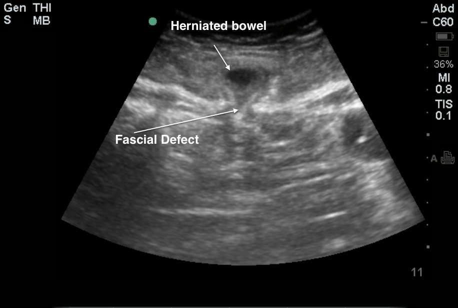 Lumbar Hernia Ultrasound