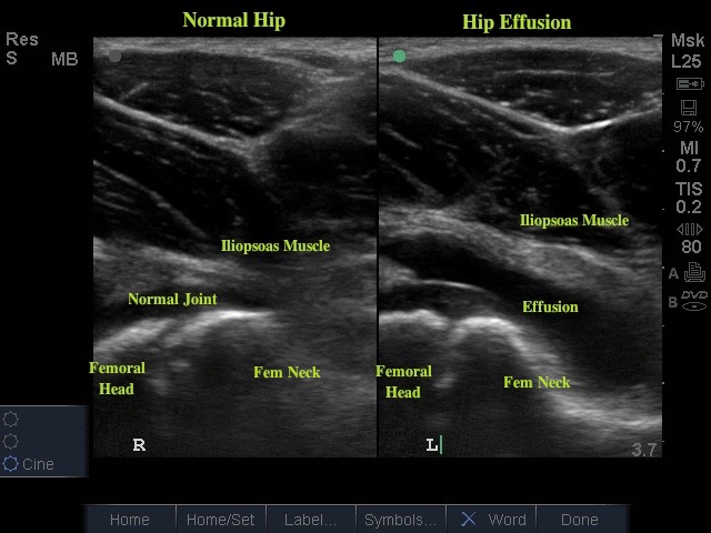 Hip Effusion | Emory School of Medicine