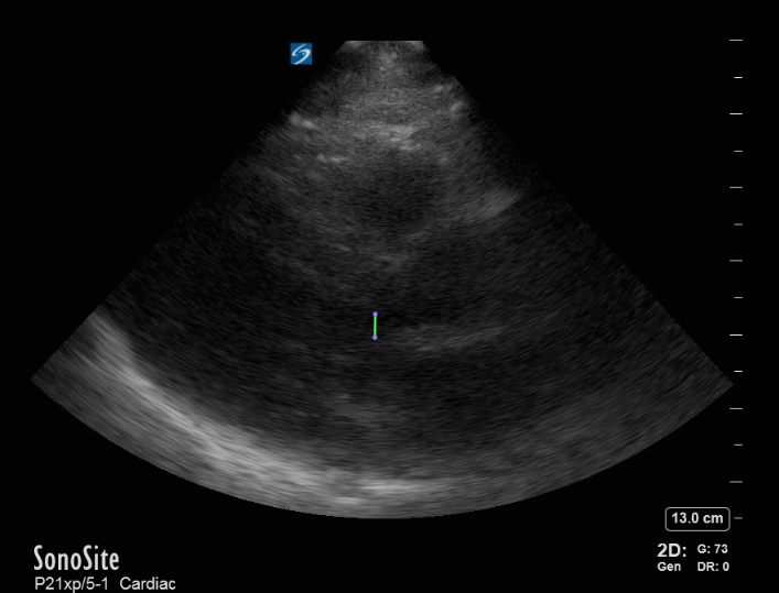 HOCM after BiPAP