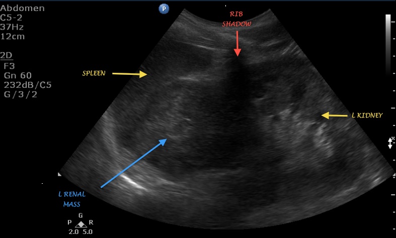 kidney ultrasound images abnormal