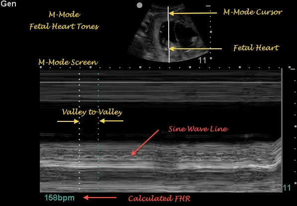 Fetal HR Determination | Emory of Medicine