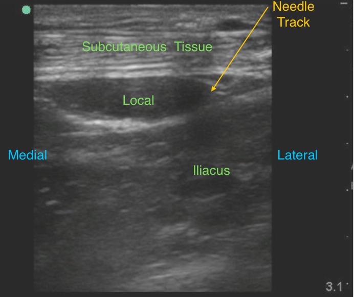 Fascia Iliaca